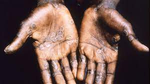 Photo of America will have biggest monkeypox outbreak in world within days: statistics